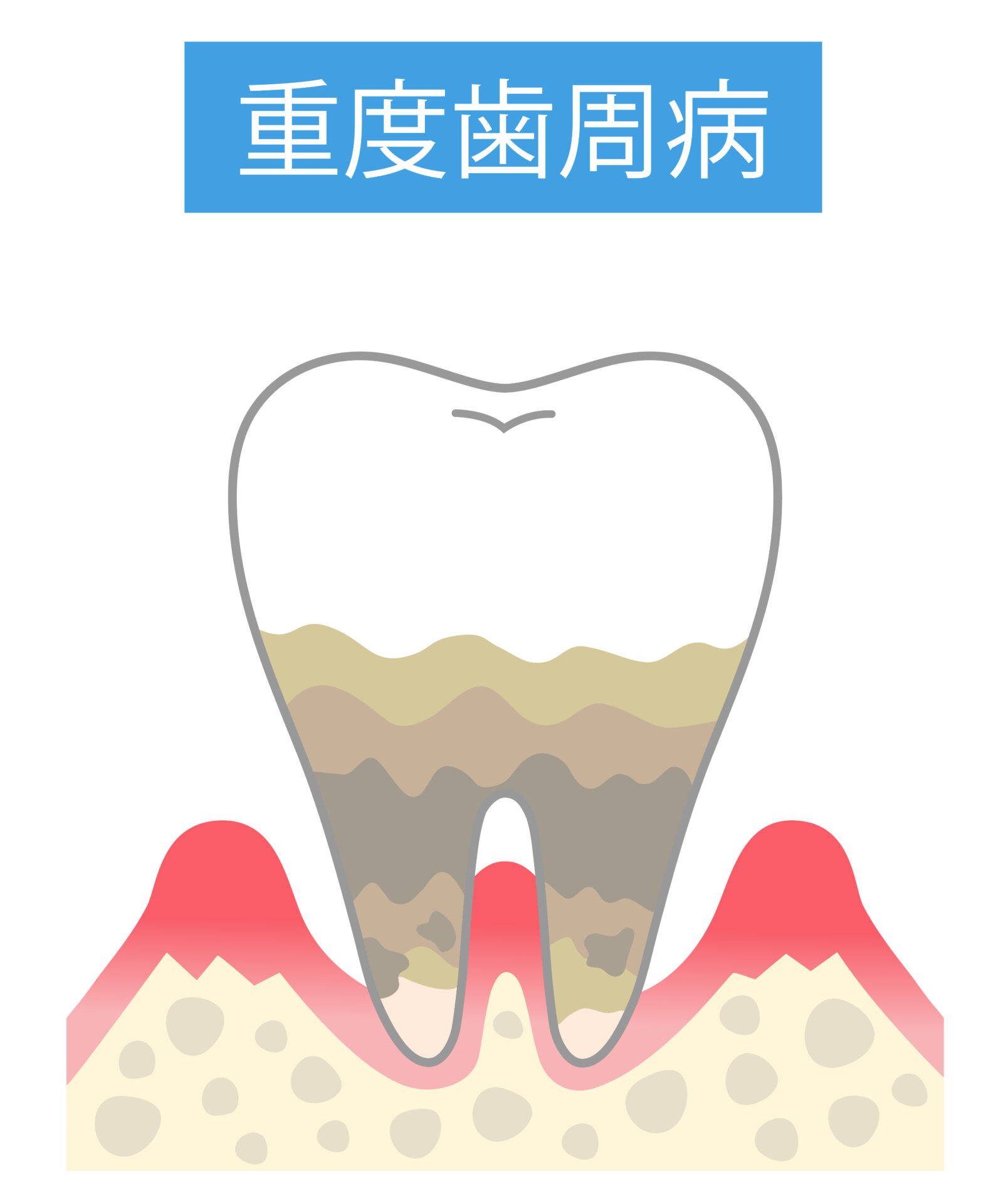 歯周病の4段階の進行度別の症状とは?治療の流れと予防法 | 細田歯科|